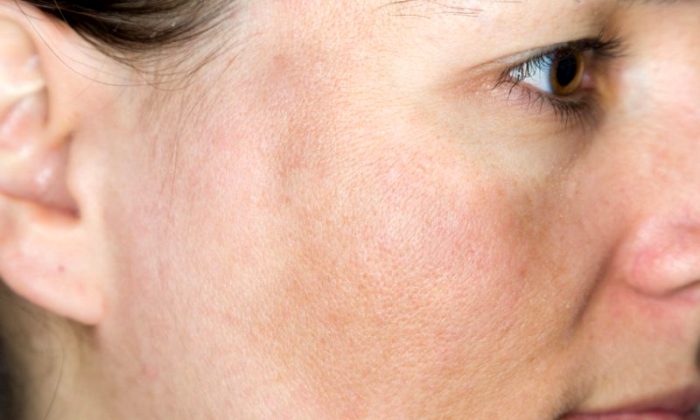 как выглядит пигментация от возраста на лице фото как выглядит пигментация от возраста на лице фото